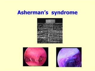 Asherman’s syndrome
 