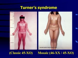 Mosaic (46-XX / 45-XO)
(Classic 45-XO)
Turner’s syndrome
 