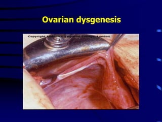 Ovarian dysgenesis
 