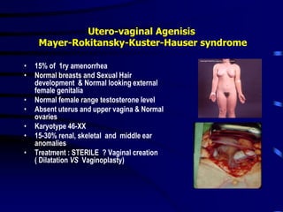 Utero-vaginal Agenisis
Mayer-Rokitansky-Kuster-Hauser syndrome
• 15% of 1ry amenorrhea
• Normal breasts and Sexual Hair
development & Normal looking external
female genitalia
• Normal female range testosterone level
• Absent uterus and upper vagina & Normal
ovaries
• Karyotype 46-XX
• 15-30% renal, skeletal and middle ear
anomalies
• Treatment : STERILE ? Vaginal creation
( Dilatation VS Vaginoplasty)
 