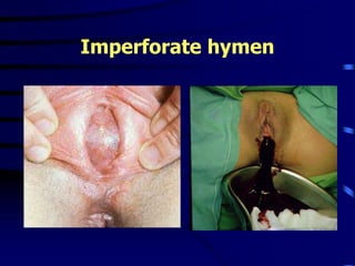 Imperforate hymen
 