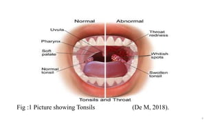 Fig :1 Picture showing Tonsils (De M, 2018).
4
 
