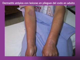 07. DERMATITIS ATOPICA DRA VELASQUEZ 2016.pptx