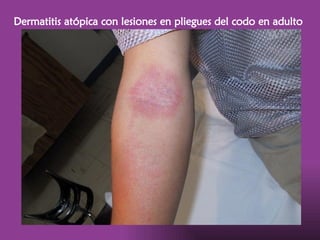 07. DERMATITIS ATOPICA DRA VELASQUEZ 2016.pptx