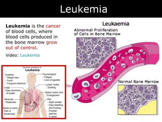Leukemia Example 07 blood disorders | PPT