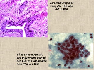 Carcinom niệu mạc
vùng đài – bể thận
(HE x 400)
Tế bào học nước tiểu
cho thấy những đám tế
bào biểu mô không điển
hình (Pap’s, x400)
 