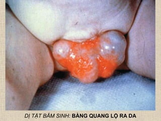 DỊ TẬT BẨM SINH: BÀNG QUANG LỘ RA DA
 