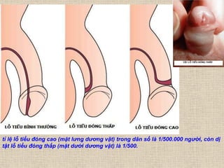 tỉ lệ lỗ tiểu đóng cao (mặt lưng dương vật) trong dân số là 1/500.000 người, còn dị
tật lỗ tiểu đóng thấp (mặt dưới dương vật) là 1/500.
 