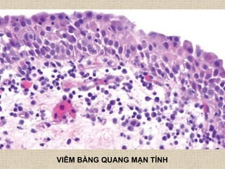 VIÊM BÀNG QUANG MẠN TÍNH
 