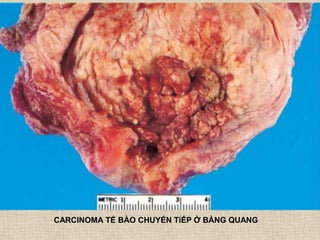 CARCINOMA TẾ BÀO CHUYỂN TiẾP Ở BÀNG QUANG
 