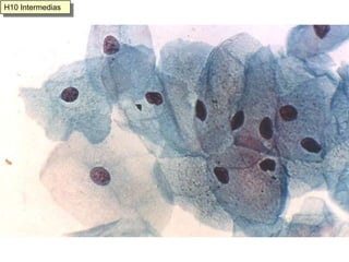 Células metaplásicas y de reserva