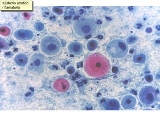 EspermatozoidesCélulas epiteliales normales en VCECélulas escamosas:SuperficialesIntermediasParabasalesCélulas endocervicalesCélulas endometriales