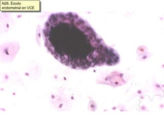 N6 Intermedias y superficial