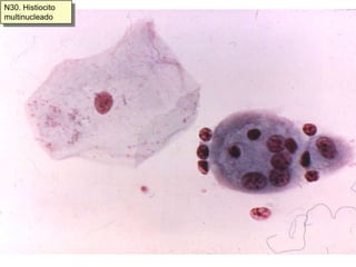 H23frotis atrófico inflamatorio