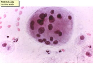 H20 Frotis atrófico en proceso autolítico