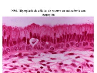 N26. Éxodo endometrial en VCE