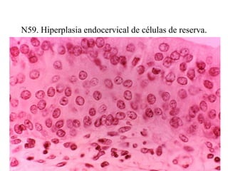 N30. Histiocito multinucleado