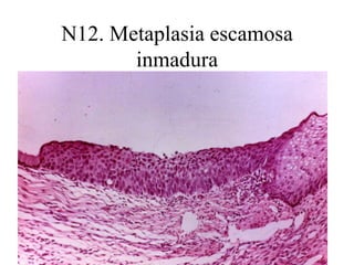 N31 Histiocito multinucleado