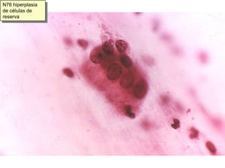 N81 metaplasia escamosa cervical