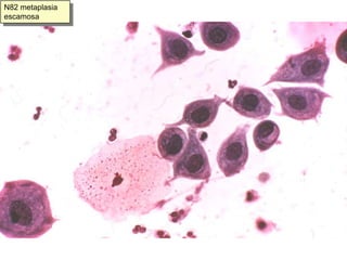 N56. Hiperplasia de células de reserva en endocérvix con ectropion