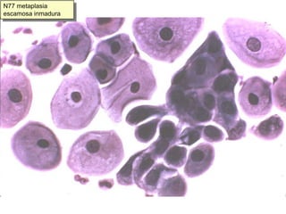 N57. Más hiperplasia de células de reserva en endocérvix
