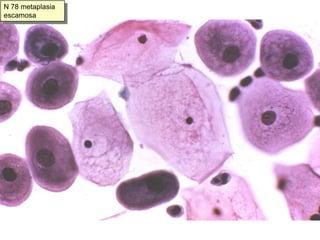 N58. Hiperplasia de células de reserva en endocérvix