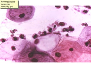 N59. Hiperplasia endocervical de células de reserva.