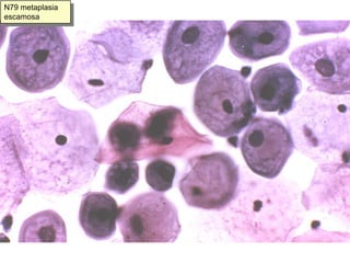 N12. Metaplasia escamosa inmadura
