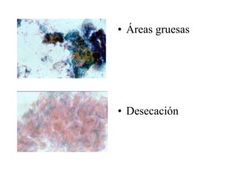 Procesada y examinada, pero insatisfactoriaDificultad para observar células (50 a 75 %) por:sangreinflamación
