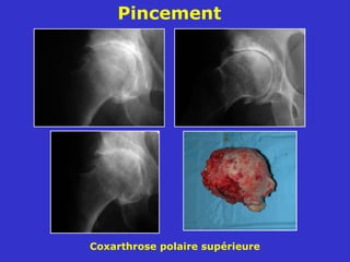 07 Coxarthrose 07 Coxarthrose