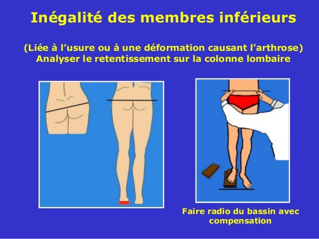 Le filet variqueux du comprimé