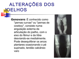 ALTERAÇÕES DOS
JOELHOS

  Genovaro: É conhecido como
   "pernas curvas" ou "pernas de
   cowboy", consiste numa
   angulação externa da
   articulação do joelho, com o
   eixo do fêmur e da tíbia
   desviando-se medialmente.
   Pode desequilibrar os arcos
   plantares ocasionando o pé
   supinado, tendão calcâneo
   varo
 