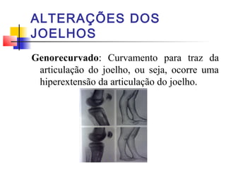 ALTERAÇÕES DOS
JOELHOS
Genorecurvado: Curvamento para traz da
 articulação do joelho, ou seja, ocorre uma
 hiperextensão da articulação do joelho.
 