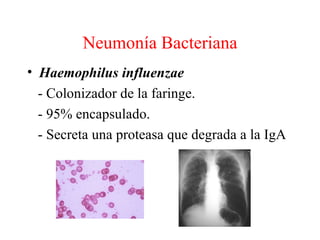 Neumonía Bacteriana
• Haemophilus influenzae
  - Colonizador de la faringe.
  - 95% encapsulado.
  - Secreta una proteasa ...