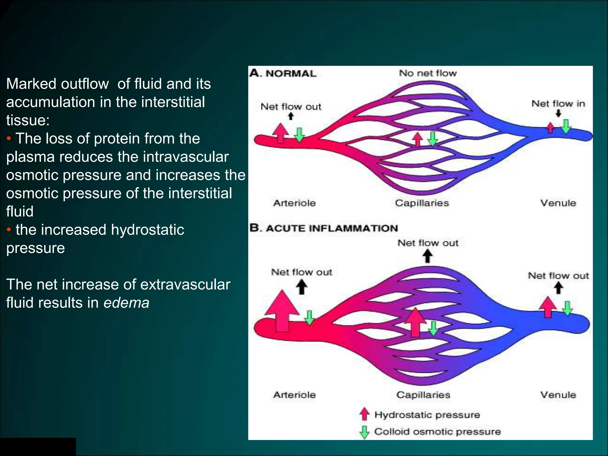 Slide 3.3
Marked outflow of fluid and its
accumulation in the interstitial
tissue:
• The loss of protein from the
plasma reduces the intravascular
osmotic pressure and increases the
osmotic pressure of the interstitial
fluid
• the increased hydrostatic
pressure
The net increase of extravascular
fluid results in edema
 