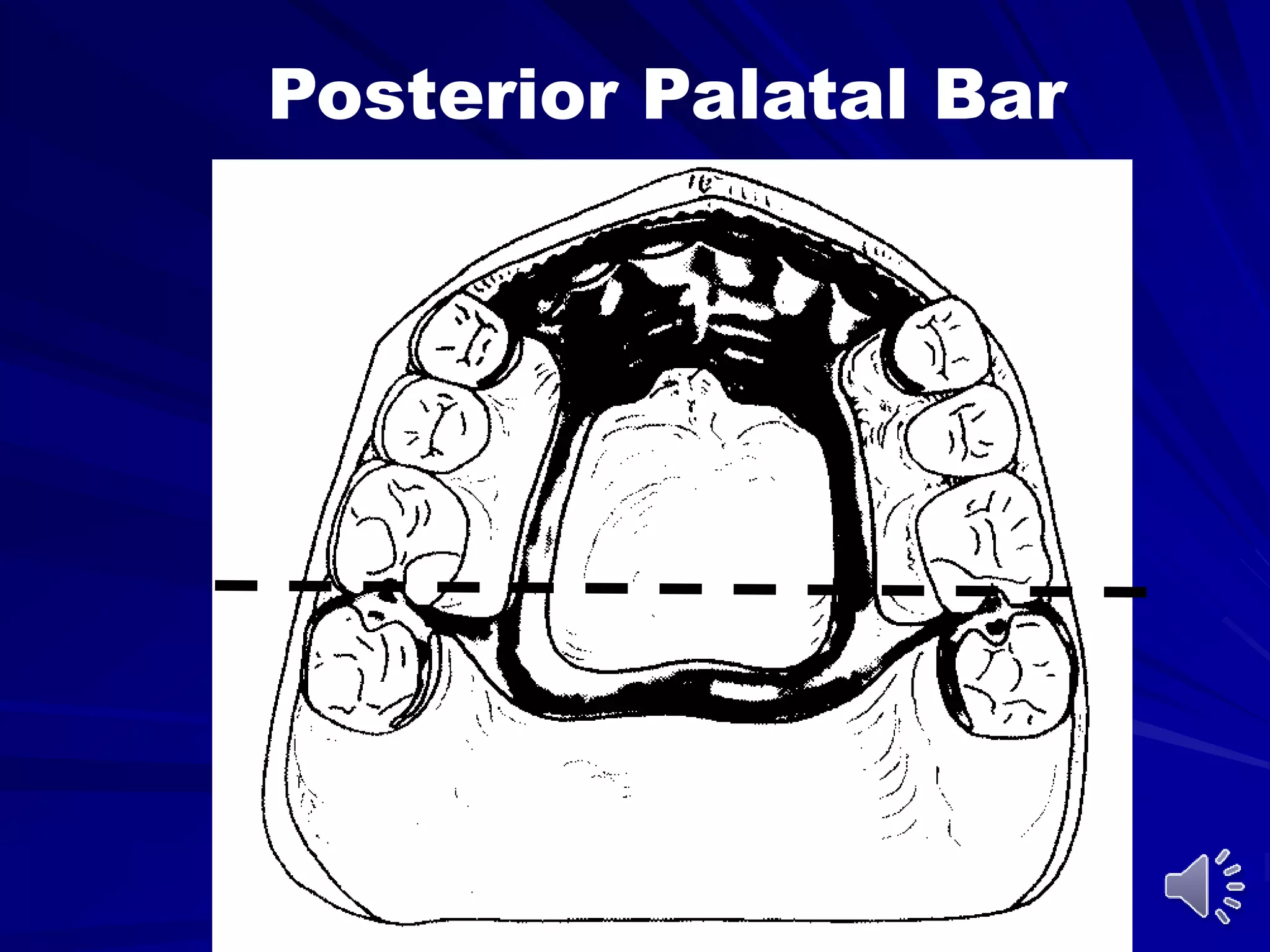 Posterior Palatal Bar
 