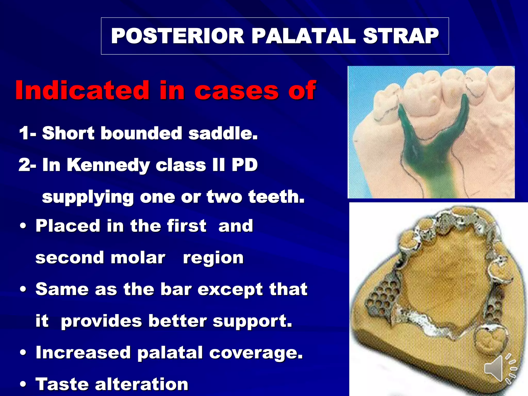 Indicated in cases of
1- Short bounded saddle.
2- In Kennedy class II PD
supplying one or two teeth.
POSTERIOR PALATAL STRAP
• Placed in the first and
second molar region
• Same as the bar except that
it provides better support.
• Increased palatal coverage.
• Taste alteration
 