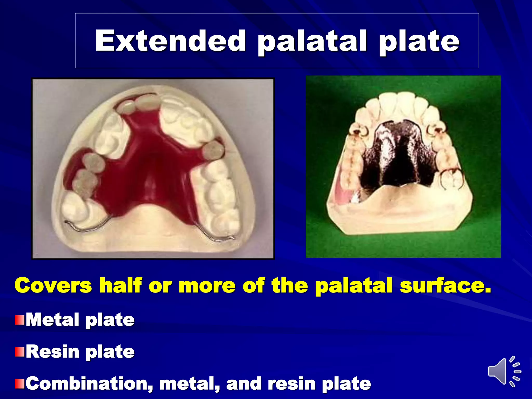 Extended palatal plate
Covers half or more of the palatal surface.
Metal plate
Resin plate
Combination, metal, and resin plate
 