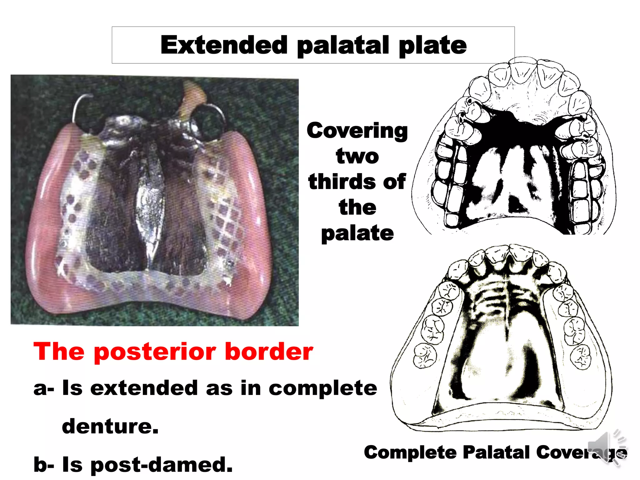 Extended palatal plate
Complete Palatal Coverage
Covering
two
thirds of
the
palate
The posterior border
a- Is extended as in complete
denture.
b- Is post-damed.
 