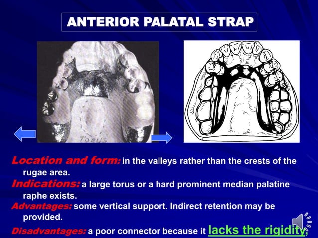 Palatable Strap Rpd Maxillary major connectors | PPT