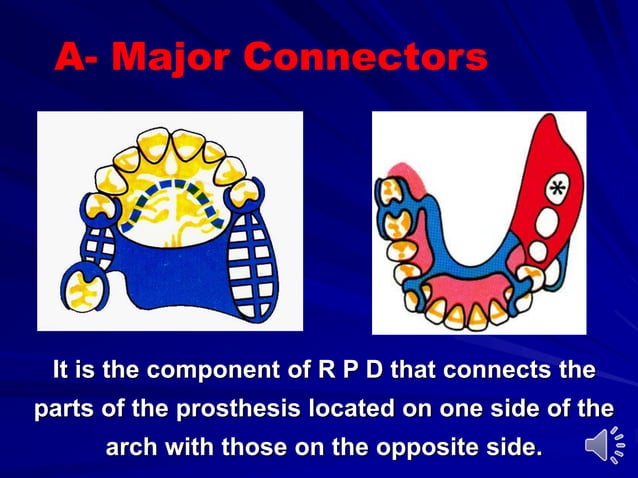 Maxillary major connectors | PPT