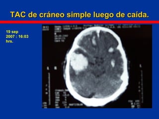 TAC de cráneo simple luego de caída.TAC de cráneo simple luego de caída.
19 sep
2007 : 16:03
hrs.
 