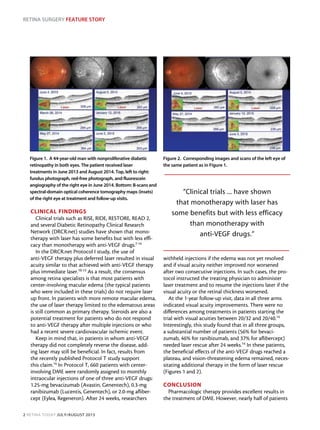 RETINA SURGERY FEATURE STORY
2 RETINA TODAY JULY/AUGUST 2015
CLINICAL FINDINGS
Clinical trials such as RISE, RIDE, RESTORE, READ 2,
and several Diabetic Retinopathy Clinical Research
Network (DRCR.net) studies have shown that mono-
therapy with laser has some benefits but with less effi-
cacy than monotherapy with anti-VEGF drugs.7-14
In the DRCR.net Protocol I study, the use of
anti-VEGF therapy plus deferred laser resulted in visual
acuity similar to that achieved with anti-VEGF therapy
plus immediate laser.10-13 As a result, the consensus
among retina specialists is that most patients with
center-involving macular edema (the typical patients
who were included in these trials) do not require laser
up front. In patients with more remote macular edema,
the use of laser therapy limited to the edematous areas
is still common as primary therapy. Steroids are also a
potential treatment for patients who do not respond
to anti-VEGF therapy after multiple injections or who
had a recent severe cardiovascular ischemic event.
Keep in mind that, in patients in whom anti-VEGF
therapy did not completely reverse the disease, add-
ing laser may still be beneficial. In fact, results from
the recently published Protocol T study support
this claim.14
In Protocol T, 660 patients with center-
involving DME were randomly assigned to monthly
intraocular injections of one of three anti-VEGF drugs:
1.25-mg bevacizumab (Avastin, Genentech), 0.3-mg
ranibizumab (Lucentis, Genentech), or 2.0-mg afliber-
cept (Eylea, Regeneron). After 24 weeks, researchers
withheld injections if the edema was not yet resolved
and if visual acuity neither improved nor worsened
after two consecutive injections. In such cases, the pro-
tocol instructed the treating physician to administer
laser treatment and to resume the injections later if the
visual acuity or the retinal thickness worsened.
At the 1-year follow-up visit, data in all three arms
indicated visual acuity improvements. There were no
differences among treatments in patients starting the
trial with visual acuities between 20/32 and 20/40.14
Interestingly, this study found that in all three groups,
a substantial number of patients (56% for bevaci-
zumab, 46% for ranibizumab, and 37% for aflibercept)
needed laser rescue after 24 weeks.14
In these patients,
the beneficial effects of the anti-VEGF drugs reached a
plateau, and vision-threatening edema remained, neces-
sitating additional therapy in the form of laser rescue
(Figures 1 and 2).
CONCLUSION
Pharmacologic therapy provides excellent results in
the treatment of DME. However, nearly half of patients
Figure 1. A 44-year-old man with nonproliferative diabetic
retinopathy in both eyes. The patient received laser
treatments in June 2013 and August 2014. Top, left to right:
fundus photograph, red-free photograph, and fluorescein
angiography of the right eye in June 2014. Bottom: B-scans and
spectral-domain optical coherence tomography maps (insets)
of the right eye at treatment and follow-up visits.
Figure 2. Corresponding images and scans of the left eye of
the same patient as in Figure 1.
”Clinical trials ... have shown
that monotherapy with laser has
some benefits but with less efficacy
than monotherapy with
anti-VEGF drugs.”
 