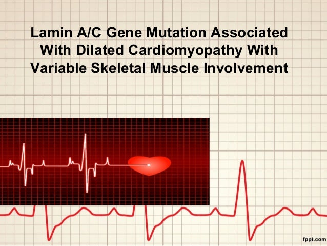 dilated cardiomyopathy