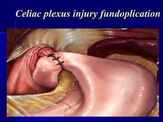 CCeliac plexus injury fundoplicationeliac plexus injury fundoplication
 