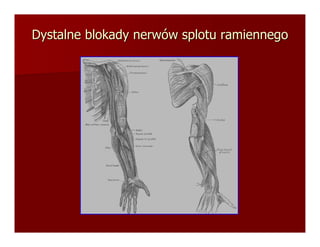 Dystalne blokady nerwów splotu ramiennego
 
