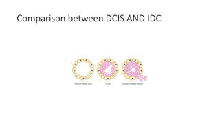 Idca Cancer BREAST CANCER PPT: A GENERAL OVERVIEW IN HISTOPATHOLOGY | PPTX