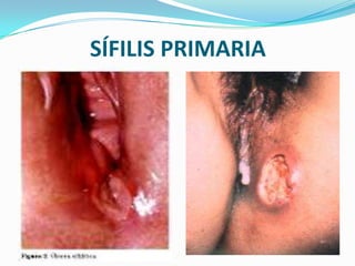 SÍFILIS PRIMARIA
 