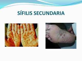 SÍFILIS SECUNDARIA
 