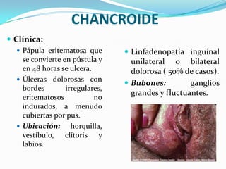 CHANCROIDE
 Clínica:
    Pápula eritematosa que        Linfadenopatía inguinal
     se convierte en pústula y      unilateral o bilateral
     en 48 horas se ulcera.         dolorosa ( 50% de casos).
    Úlceras dolorosas con
                                   Bubones:         ganglios
     bordes        irregulares,
                                    grandes y fluctuantes.
     eritematosos           no
     indurados, a menudo
     cubiertas por pus.
    Ubicación:      horquilla,
     vestíbulo, clítoris y
     labios.
 